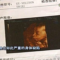医院：漏诊赔21万元】2018年12月17日，四川德阳怀孕24周的罗蕊（化名）做了四维彩超检查，孕检报告...