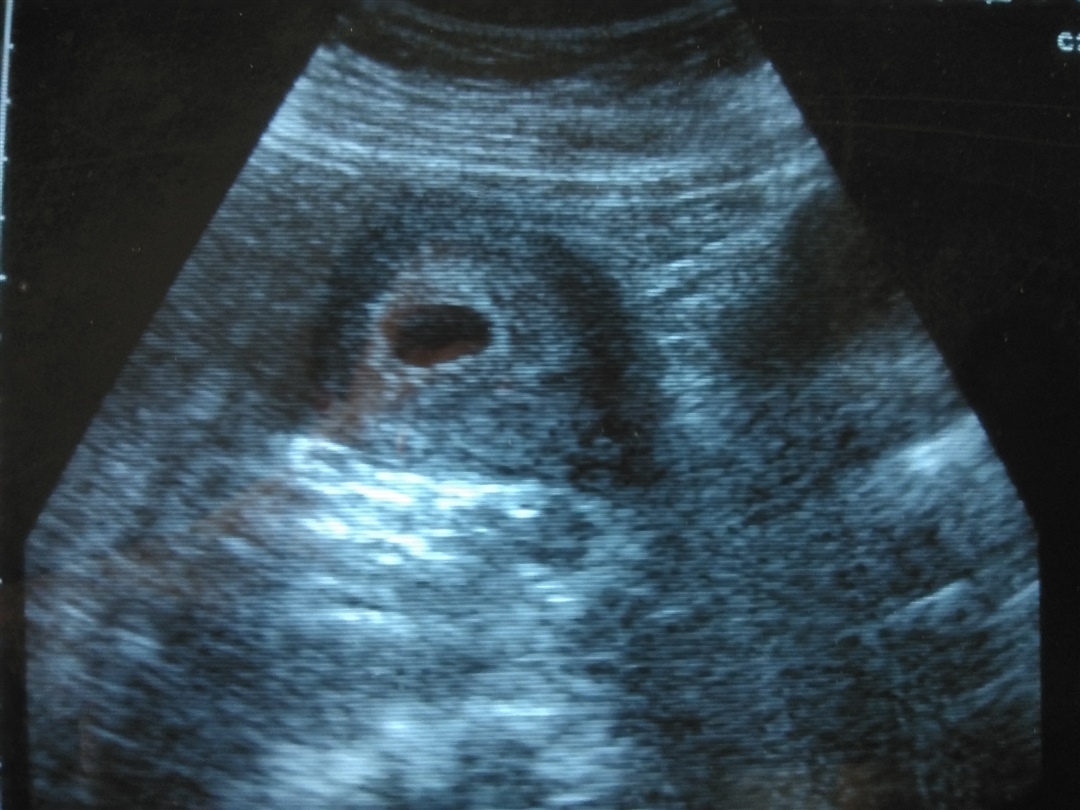 谁会看孕囊男孩女孩