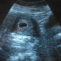 看孕囊男女 谁会看孕囊男孩女孩 谁能帮我看一下，男孩女孩