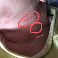 宝妈给看看啊，宝宝脖子上长的这些又不像湿疹，好大一粒一粒的，感觉像是虫子或者是过敏呀，实在好着急...