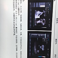 有知道的么？？医生说还小。建议一周后复查。。我这是怀孕了吧😂😂。。测了有双杠。3月15末次月经。...