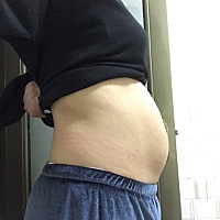 生完第10天了，肚子小了点，不知道还要多久恢复孕前状态，宝宝脸上和脖子长了很多湿疹，天天用艾叶洗澡...