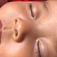 五个月大宝宝鼻子两边发黄，别的都没有问题，不知道怎么回事，有没有宝宝也这样的