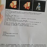 麻烦大家帮我看看羊水正常吗…… 刚刚照四维的时候，大脑有两块好像是空的，没有积水，但是有两块是空的...