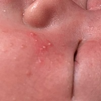 宝宝出生20多天了 脸上突然出现这种像痘痘一样的东西 不知道是湿疹还是新生儿痤疮 有一样的宝宝吗？该怎...