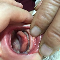 宝宝刚出生时嘴巴就长了一颗肉粒现在一个多月了还在，有没有类似的，后面自己会好吗？