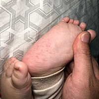 女儿10个月，突然发现脚底长了这样的红点，求鉴定。昨天喂她吃了菠菜和婴儿辅食肉松。体温不高，身上其...