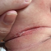 宝宝淹脖子破皮了，怎么办