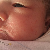 宝宝起了好多湿疹不知道是过敏还是，，，医生给开的这个，不知道管用不，先用几天，