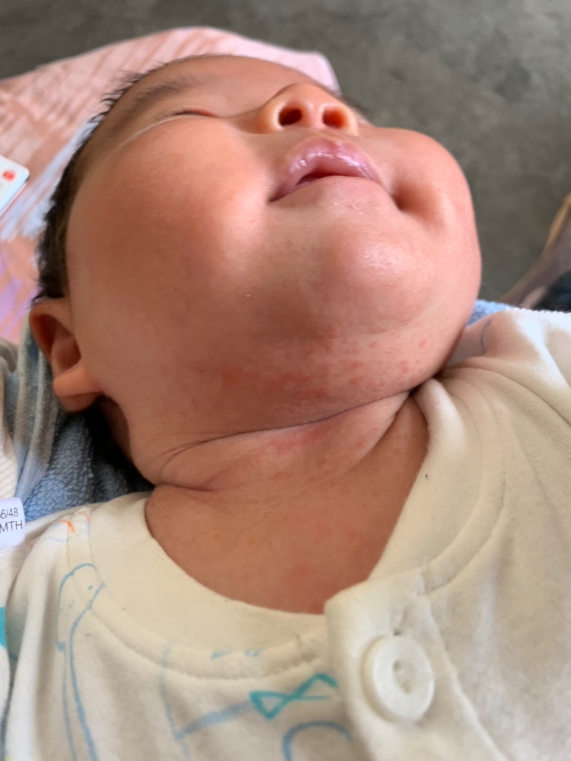 请问这脖子下面是什么啊，是湿疹吗