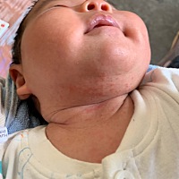 请问这脖子下面是什么啊，是湿疹吗