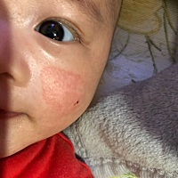 有宝妈知道脸上是什么吗？有点发硬还红