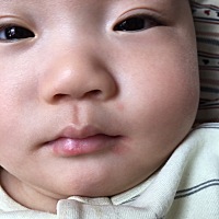 宝宝六个半月，今天吃了两种溶豆，一种蛋黄溶豆，一种酸奶溶豆，吃完两分钟就都这样嘴周围起红包。有没...