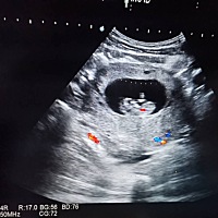 马上要四维了、一直纠结要不要知道性别，二胎、好怕不能如愿。反而影响了心情。