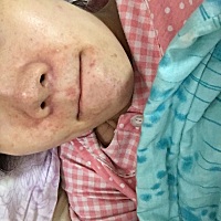 月子中的我这脸是怎么了？毁容了