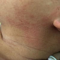 两个月的宝宝，脸上干干的，起死皮，怎么回事