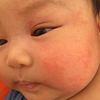 看着像湿疹，怎么治