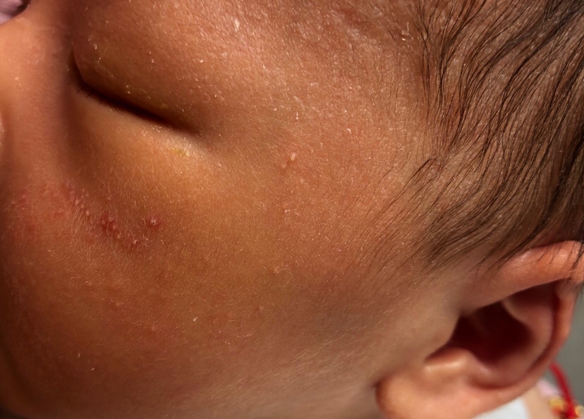 有没有专业人士知道宝宝脸上的这个是怎么回事呢？大夫说是太热的缘故，已经给宝宝减衣服了，怎么还会有呢？