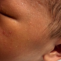 有没有专业人士知道宝宝脸上的这个是怎么回事呢？大夫说是太热的缘故，已经给宝宝减衣服了，怎么还会有呢？