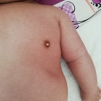 宝妈们知道宝宝乳头上的白点是什么，要不要紧