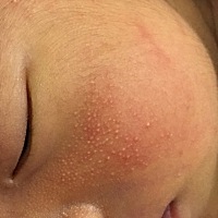 求各位有经验的宝妈们，帮我看看我宝宝脸上这些粒粒是什么呀？该怎么解决