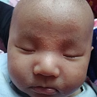 宝宝49天了脸上有湿疹怎么办，看着好心疼啊