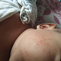 宝宝脸上长痱子了