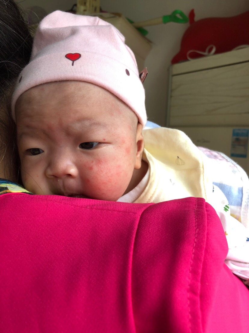 宝妈们，我想问哈宝宝脸上这个是什么东东……需要去买药擦吗？之前都还没有，这几天越冒越多了……看着好恼火的样子