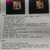 四维检查，左心室有强光点。大家有没有遇到的？都是又做的哪些检查