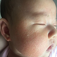 宝宝之前湿疹然后就变成这样了，有没有跟我有过类似有经验的宝妈，怎样才能让宝宝好起来？