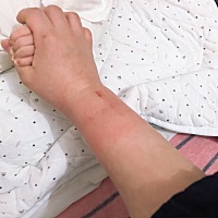 产后四十多天开始是是右手腕上截疼，到后来两手腕都疼，疼厉害时穿衣服都困难，但是手指可以动，做个艾...