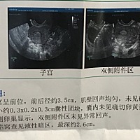 Hcg检查＜0.5也就是没怀孕，宫内囊性团块是什么？好担心，是不是长了什么东西？