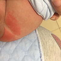 宝宝红屁屁了，用什么药膏好用？求推荐！！