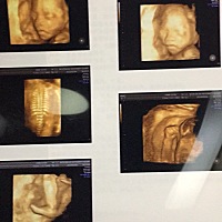 5月4号做的四维 宝宝很乖差不多20分钟就好了 妈妈说跟儿子出生的时候很像 像孩子爸爸 愿我的小宝贝...