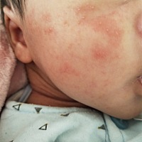 宝妈们知不知道宝宝脸上起的是什么呀？？需要用药嘛？宝宝21天……