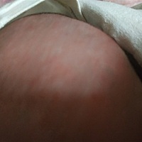 各位宝妈我家宝宝脸上头上都是红疹子，请问这个是什么原因，需要图什么药呢？