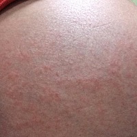 33周了肚皮痒死了，有没有宝妈也有这些的情况的