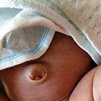 请问宝妈们，这个肉球是怎么回事，是脐疝吗，昨天还没有的，出生快1个月了