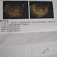 请问亲们这是怀孕了吗？可以确定是宫内受孕吗？排除是宫外孕了吗？有知道的吗？医生说不确定一个星期后...