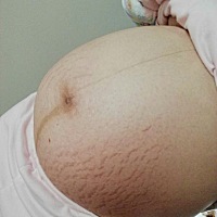 在症状对比之前最好是生二胎，然后跟自己的症状对比，因为跟其他人对比会有出入 1  大宝肚子很软，二宝...