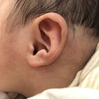 宝宝这是湿疹吗？涂什么啊？好着急