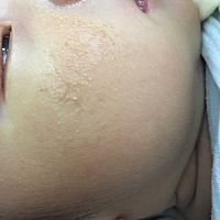 这是湿疹吗？