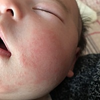 谁知道宝宝脸上长的是啥   求解决方法