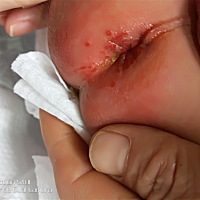 我儿子红屁屁怎么办，搽了紫草油越来越严重了…