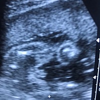 孕五月小诊所看了三次说是女宝宝，现在6个半月，换了一家，说是男宝宝。我拍了B超图大家帮我看看会不会...