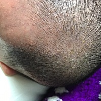 大家知道宝宝头上和下巴长的是什么吗？头上黄色的是湿疹还是痱子？下巴是奶藓吗？