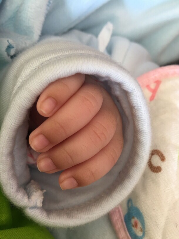 有哪位朋友知道宝宝手指头这是怎么了