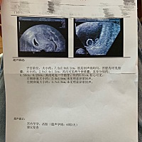 大家快来帮我看看我的B超单 3.11末次月经～4.29第一次照B超提示：可见卵黄囊，未见胎芽胎心，医生说两周...