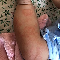 宝贝湿疹一直好不了～药膏也擦 润肤霜也涂 口也忌～全身都是～有么有类似的宝妈😣