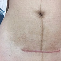 平时护理的那么好伤口还是增生了☹️☹️ 两个月都没有吃过葱、姜、蒜☹️☹️ 还是一样长出疤来☹️☹️